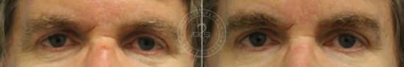 Blepharoplasty before and after photos in Miami Beach, FL, Patient 2955