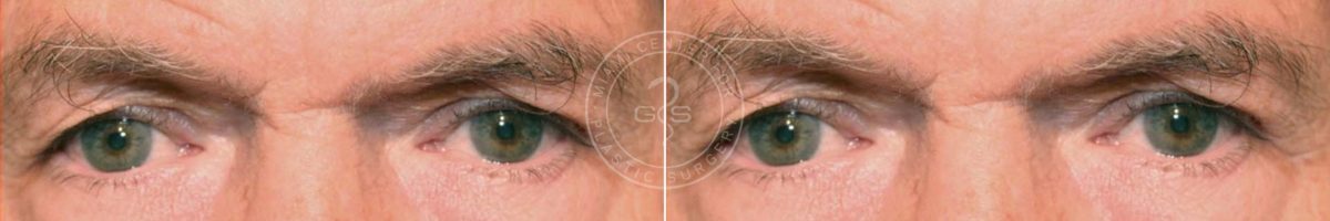 Blepharoplasty before and after photos in Miami Beach, FL, Patient 2959