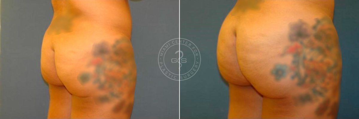 Body Sculpting before and after photos in Miami Beach, FL, Patient 2963