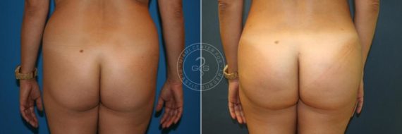 Body Sculpting before and after photos in Miami Beach, FL, Patient 2985