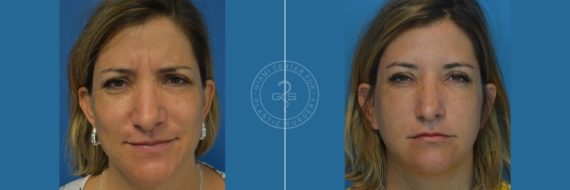 Botox before and after photos in Miami Beach, FL, Patient 2995