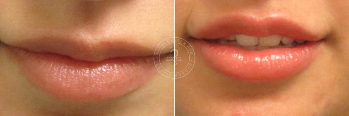 Fillers & Injectables before and after photos in Miami Beach, FL, Patient 3127