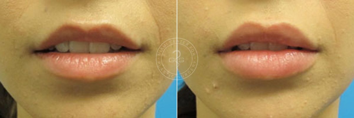 Fillers & Injectables before and after photos in Miami Beach, FL, Patient 3403