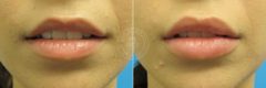 Fillers & Injectables before and after photos in Miami Beach, FL, Patient 3403