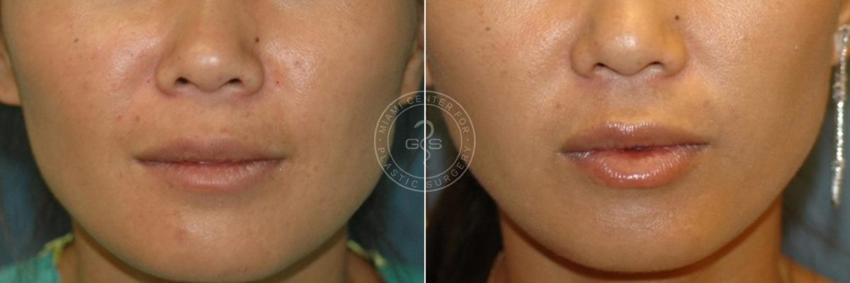 Fillers & Injectables before and after photos in Miami Beach, FL, Patient 3407