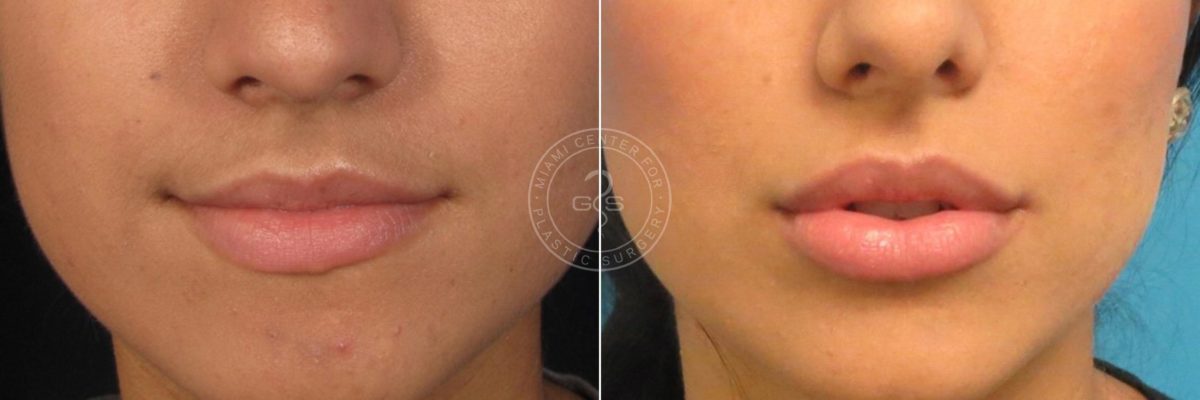 Fillers & Injectables before and after photos in Miami Beach, FL, Patient 3123