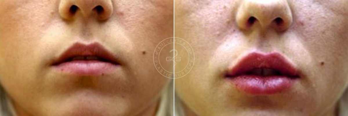 Fillers & Injectables before and after photos in Miami Beach, FL, Patient 3373