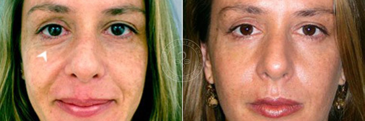 Fillers & Injectables before and after photos in Miami Beach, FL, Patient 3377