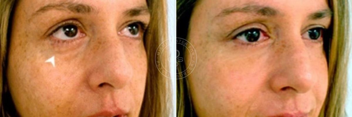 Fillers & Injectables before and after photos in Miami Beach, FL, Patient 3377
