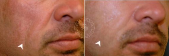 Fillers & Injectables before and after photos in Miami Beach, FL, Patient 3388