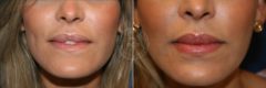 Fillers & Injectables before and after photos in Miami Beach, FL, Patient 3395
