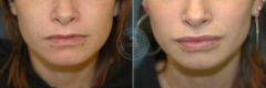 Fillers & Injectables before and after photos in Miami Beach, FL, Patient 3399