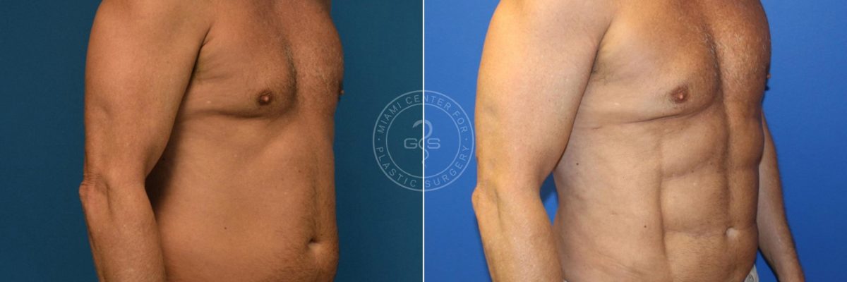 Liposculpting - Abdominal Etching before and after photos in Miami Beach, FL, Patient 3131