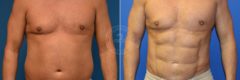 Liposculpting - Abdominal Etching before and after photos in Miami Beach, FL, Patient 3131