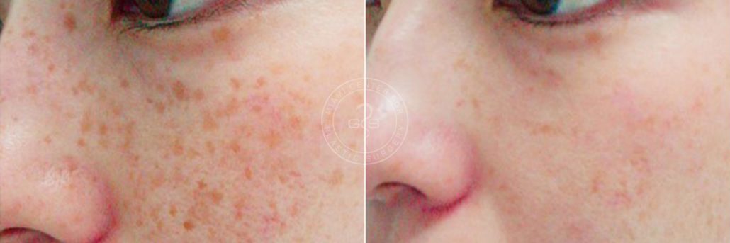 patient-3149-laser-treatment-before-after