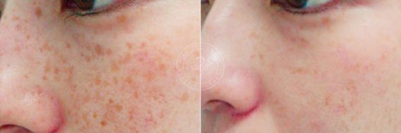 Laser Treatment before and after photos in Miami Beach, FL, Patient 3153