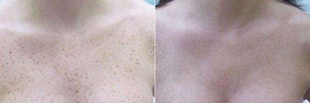 patient-3149-laser-treatment-before-after