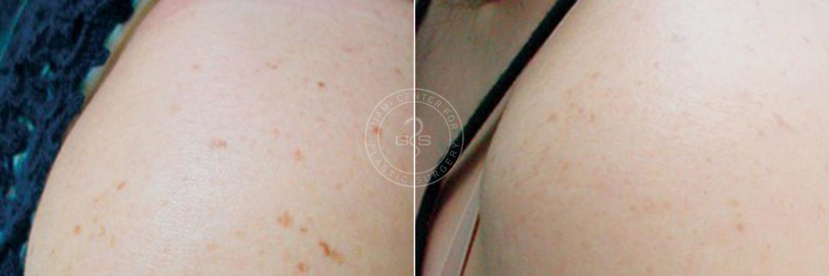 Laser Treatment before and after photos in Miami Beach, FL, Patient 3157