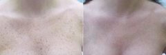 Laser Treatment before and after photos in Miami Beach, FL, Patient 3149