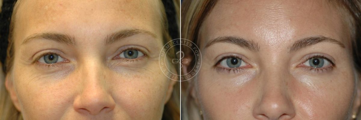Laser Treatment before and after photos in Miami Beach, FL, Patient 3161
