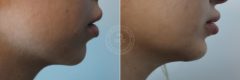 Chin Augmentation with Implant before and after photos in Miami Beach, FL, Patient 3172