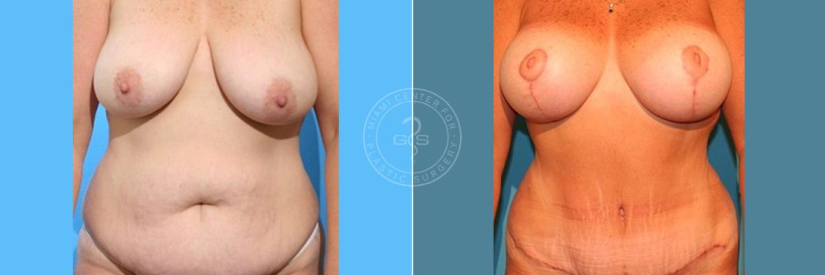 Breast Reduction & Tummy Tuck before and after photos in Miami Beach, FL, Patient 3176