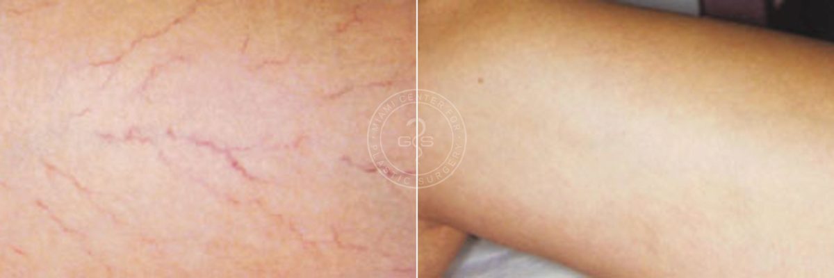 Vein Treatment before and after photos in Miami Beach, FL, Patient 3188