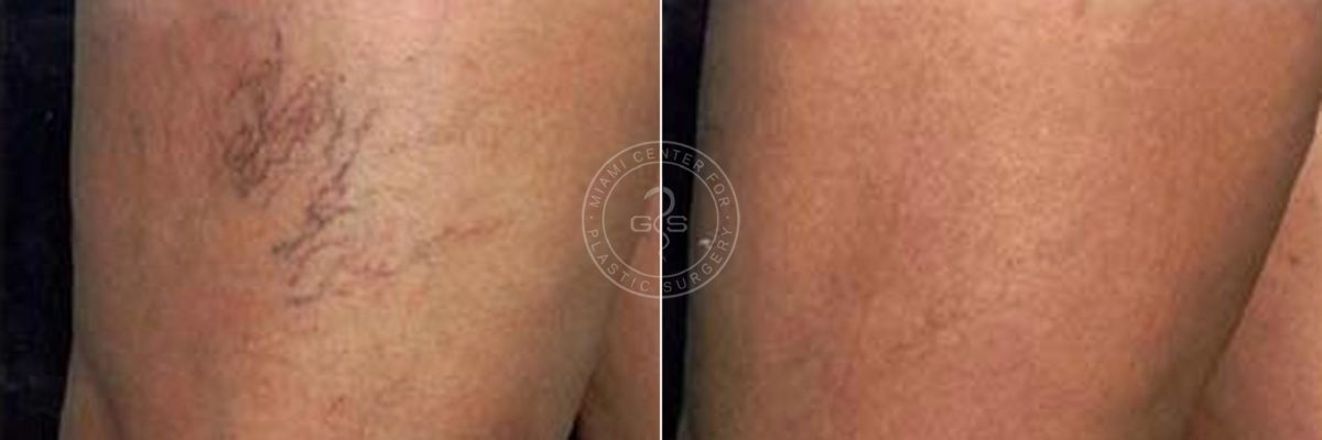 Vein Treatment before and after photos in Miami Beach, FL, Patient 3192