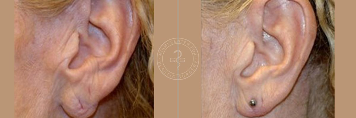 Otoplasty before and after photos in Miami Beach, FL, Patient 3246