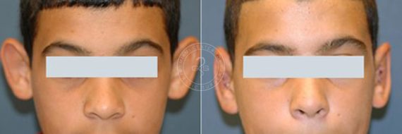 Otoplasty before and after photos in Miami Beach, FL, Patient 3253