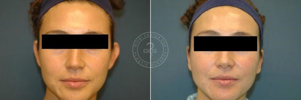 Otoplasty before and after photos in Miami Beach, FL, Patient 3263