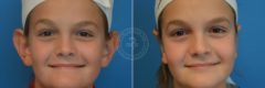 Otoplasty before and after photos in Miami Beach, FL, Patient 3267