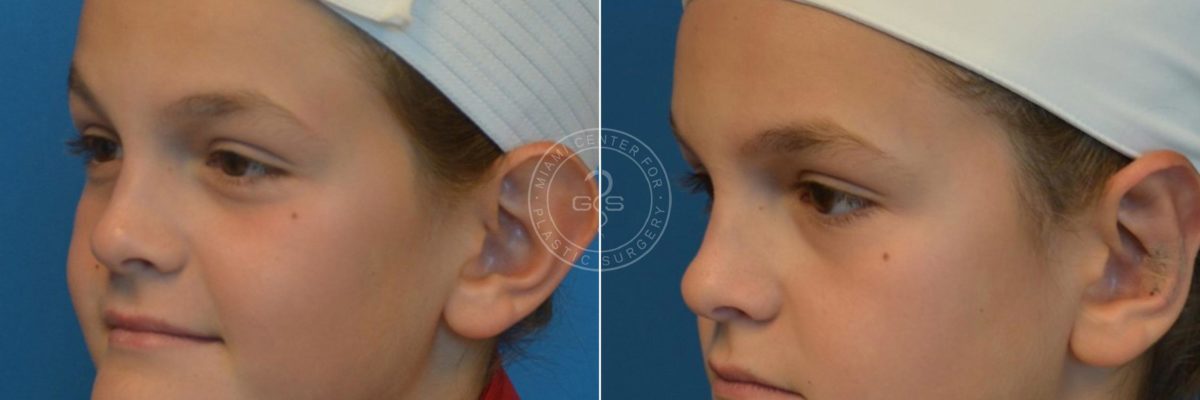 Otoplasty before and after photos in Miami Beach, FL, Patient 3267