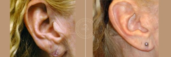 Otoplasty before and after photos in Miami Beach, FL, Patient 3246