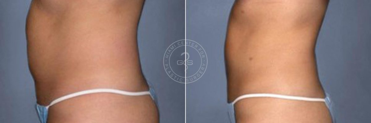 Liposuction before and after photos in Miami Beach, FL, Patient 3277