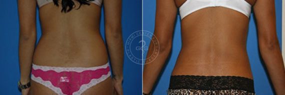 Liposuction before and after photos in Miami Beach, FL, Patient 3315