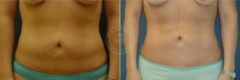 Liposuction before and after photos in Miami Beach, FL, Patient 3322