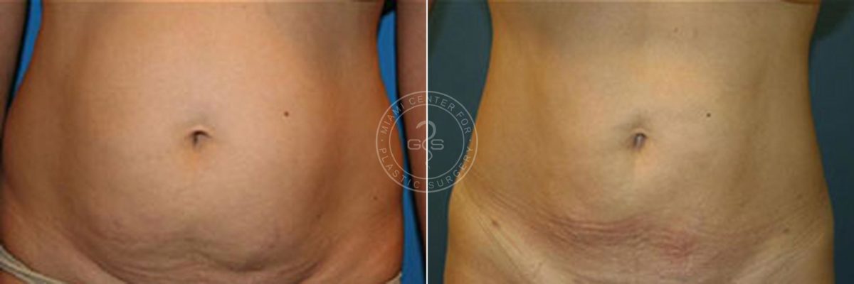 Liposuction before and after photos in Miami Beach, FL, Patient 3326