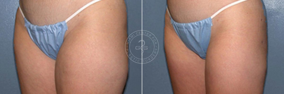 Liposuction before and after photos in Miami Beach, FL, Patient 3330