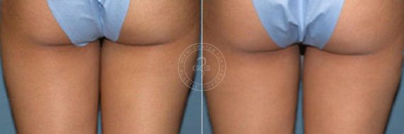 Liposuction before and after photos in Miami Beach, FL, Patient 3284