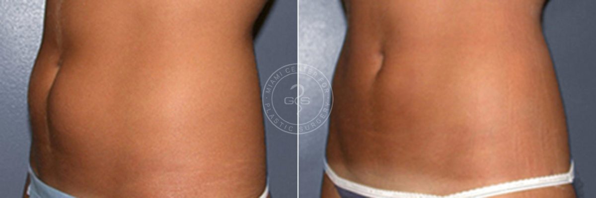 Liposuction before and after photos in Miami Beach, FL, Patient 3288