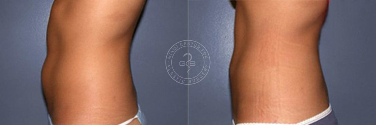 Liposuction before and after photos in Miami Beach, FL, Patient 3288