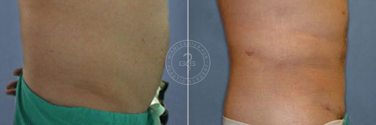 Liposuction before and after photos in Miami Beach, FL, Patient 3301