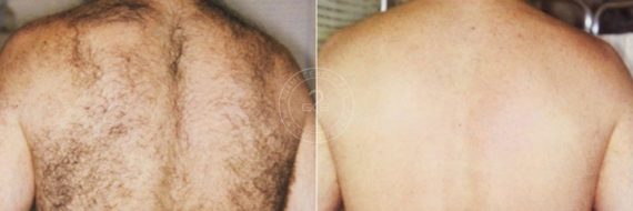 Laser Hair Removal before and after photos in Miami Beach, FL, Patient 3349