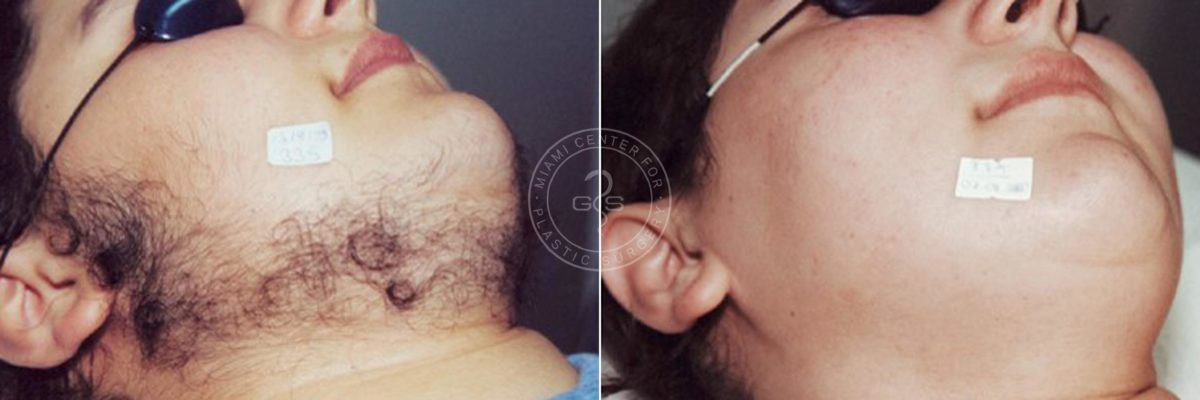 Laser Hair Removal before and after photos in Miami Beach, FL, Patient 3353