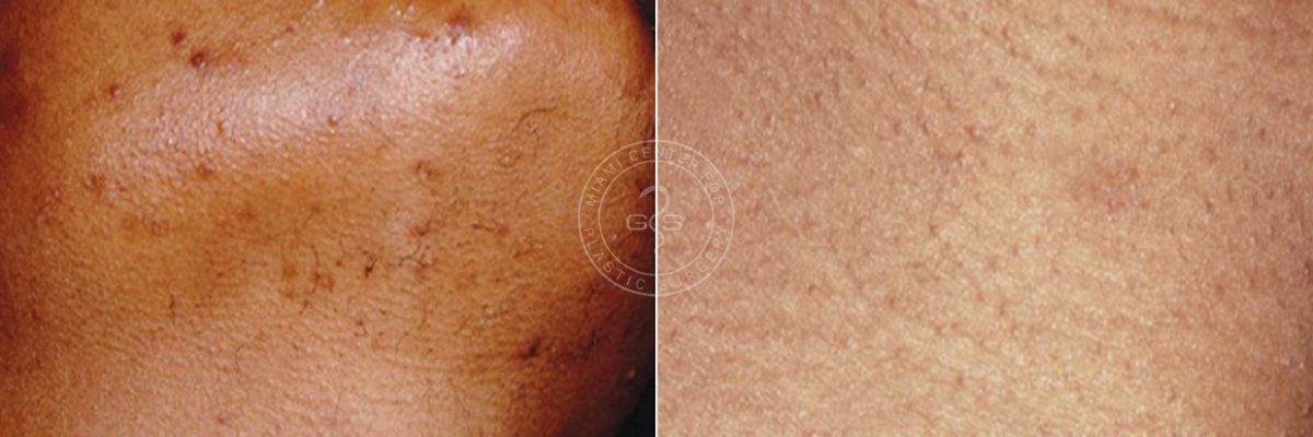 Laser Hair Removal before and after photos in Miami Beach, FL, Patient 3357
