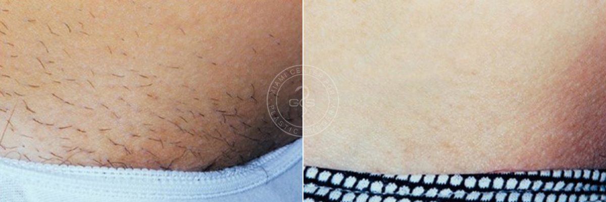Laser Hair Removal before and after photos in Miami Beach, FL, Patient 3365