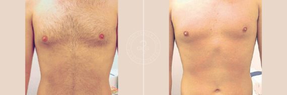 Laser Hair Removal before and after photos in Miami Beach, FL, Patient 3369