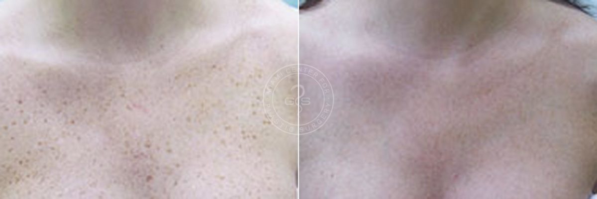Laser Hair Removal before and after photos in Miami Beach, FL, Patient 4388