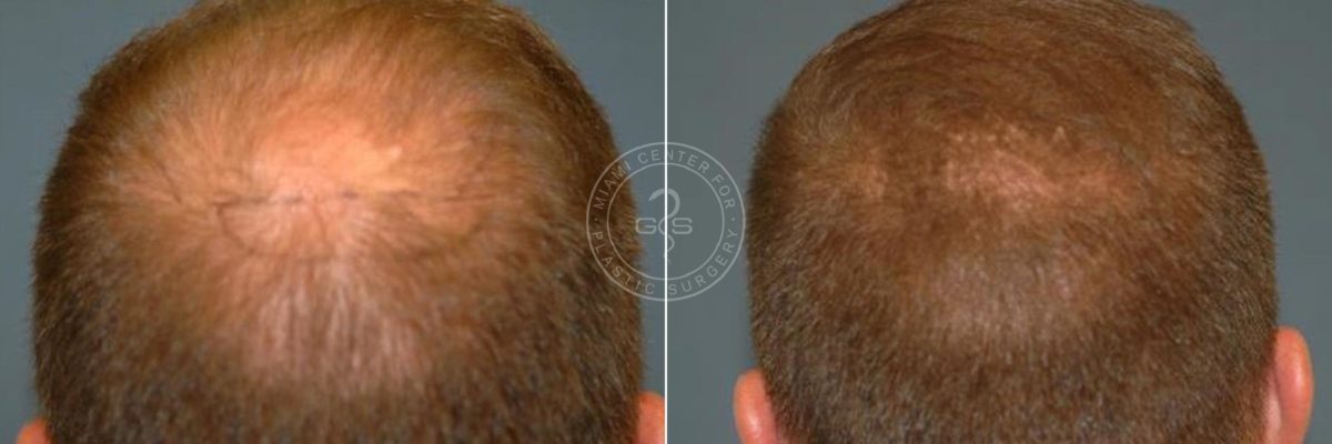 Hair Transplant before and after photos in Miami Beach, FL, Patient 3412